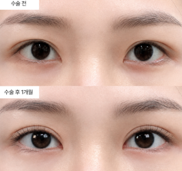 눈재수술 결과, 처음 수술보다 더 오래 유지될 수 있을까요?