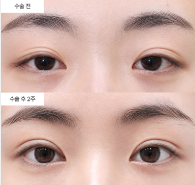안검하수가 쌍꺼풀 수술로 해결된다는 게 사실인가요?