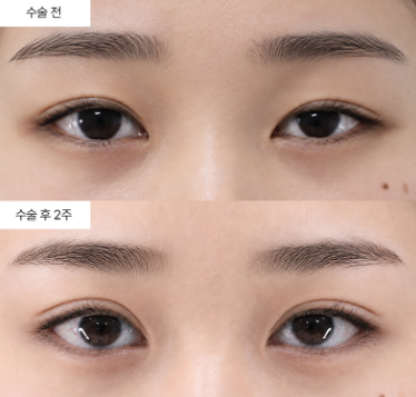안검하수 재수술, 언제 고려해야 할까요?