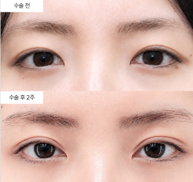 안검하수 수술 후 재발하면 다시 수술해야 하나요?