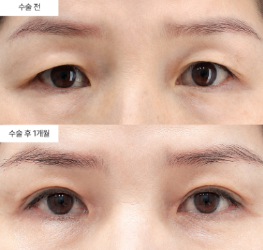 상안검 재수술, 언제 고려해야 할까요?