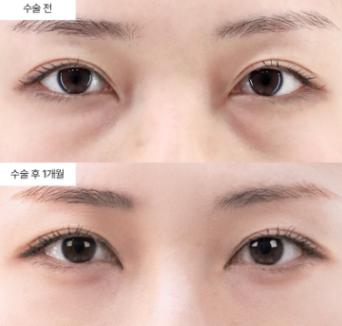 눈밑지방재배치 흉터 라인, 어디에 생기나요?