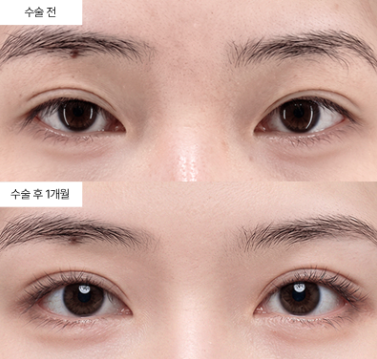 눈재수술 라인을 올리거나 내릴 때, 의사가 고민하는 것들