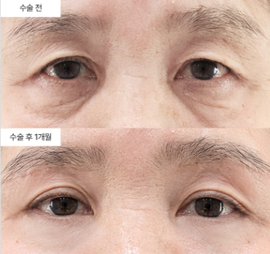 하안검 절개 라인은 어떤 위치로 결정되나요?