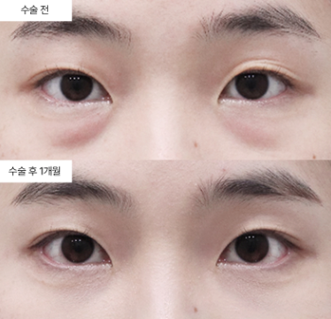 눈밑지방재배치 재수술, 언제 고려해야 할까요?