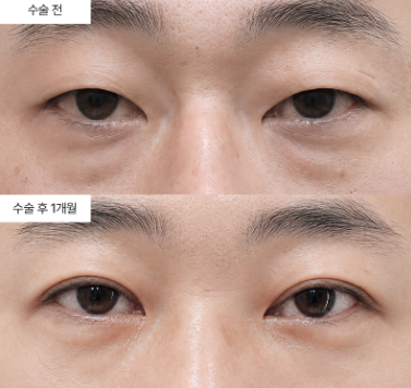 눈밑지방재배치, 왜 시간이 지나면 다시 꺼지나요?