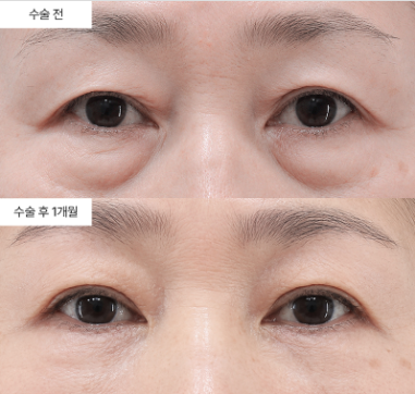 하안검 수술이 다크서클 없애는 데 효과 있나요?