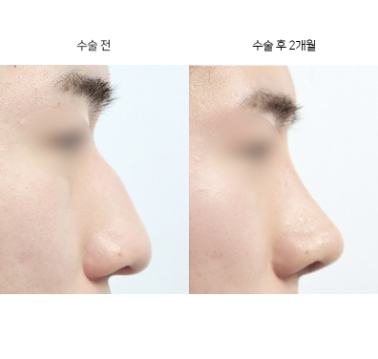 코끝성형 후 실밥은 언제 제거하나요?