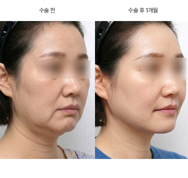 실리프팅 재수술, 언제 다시 고려해야 할까요?