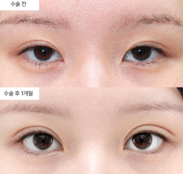 눈매교정 절개법 vs 매몰법, 내 눈에 맞는 방법은 따로 있어요