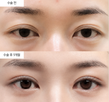 안검하수 수술, 언제 받는 게 가장 좋을까요?