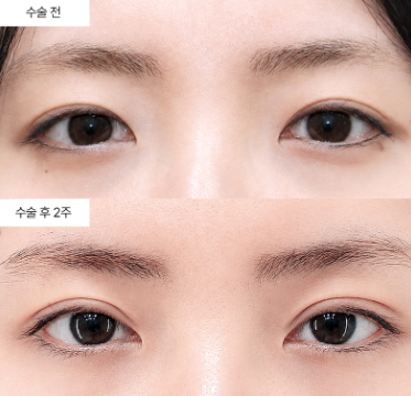 쌍꺼풀 매몰법이랑 절개법, 마취랑 통증은 얼마나 다를까요?