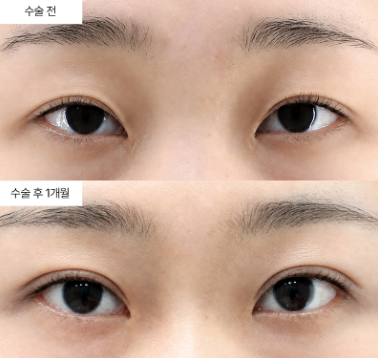 안검하수는 눈꺼풀 처짐이랑 같은 건가요?