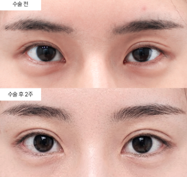 눈성형 비용이 저렴한 곳은 왜 조심해야 하나요?