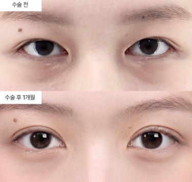 눈밑지방재배치 실패 후 재수술, 정말 가능한가요?