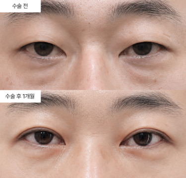 눈밑지방재배치, 왜 다크서클이 생겨도 꼭 필요한 건가요?