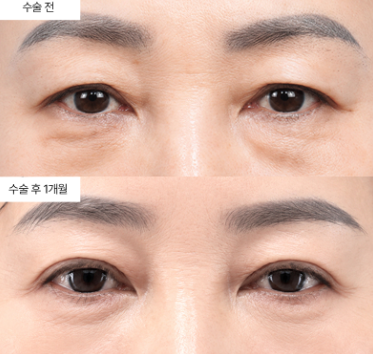 상안검 재수술, 언제쯤 고려해야 할까요?