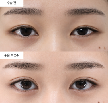 눈매교정 매몰법이랑 절개법, 마취랑 통증은 어떻게 달라요?