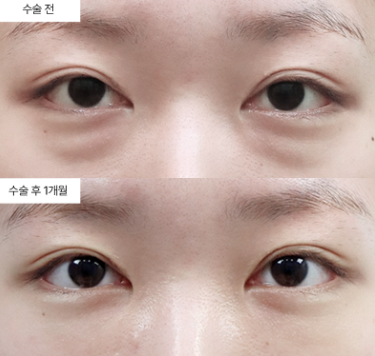 눈밑지방재배치 라인이 어색하게 잡히는 경우도 있나요?