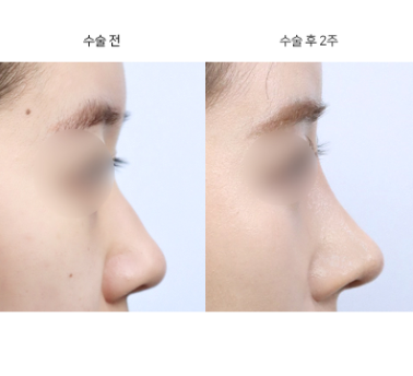 콧대성형 라인, 높게 할지 자연스럽게 할지 어떻게 고르나요?