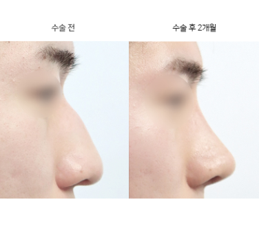 코끝성형, 몇 살 이후에 받는 게 좋을까요?