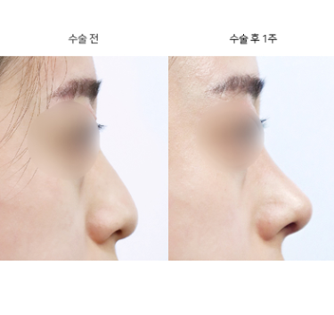 매부리코 교정하면 옆모습 라인이 어떻게 달라지나요?
