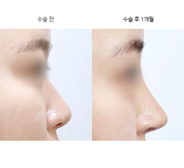 코끝성형 라인, 어떻게 선택하는 게 맞을까요?