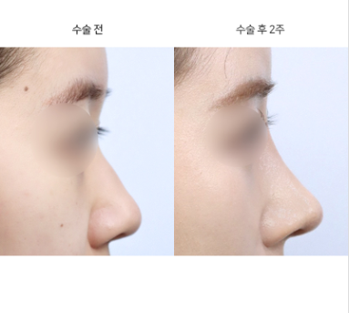 매부리코 재수술, 언제 고려해야 할까요?