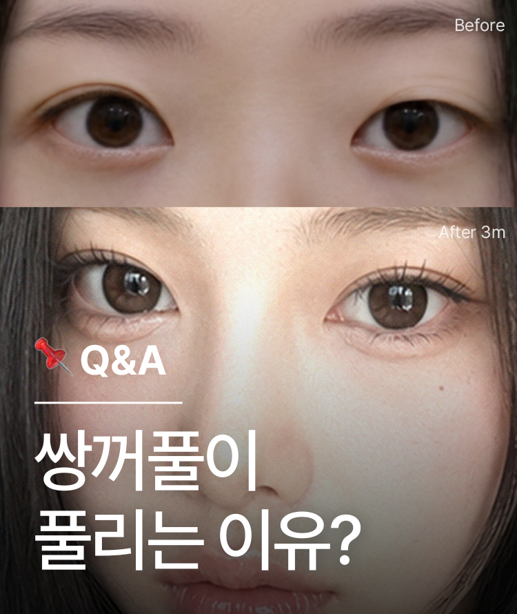 쌍꺼풀이 자꾸 풀리는 이유는?