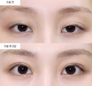 쌍꺼풀 절개랑 비절개, 회복 과정이 이렇게 다를 줄 몰랐어요