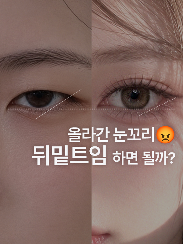 눈꼬리가 올라가서 사나워 보여요. 뒤밑트임을 하면 인상이 부드러워질까요?