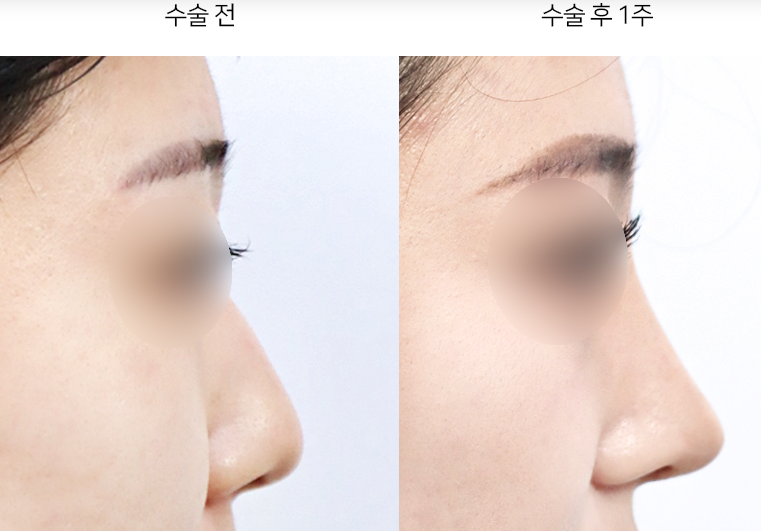 코끝성형 후 붓기, 완전히 빠지는 데 얼마나 걸릴까요?