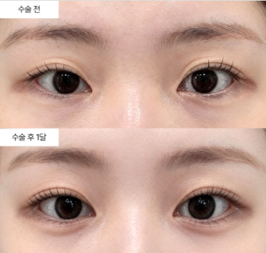 눈성형 후 붓기, 완전히 빠지는 데 얼마나 걸릴까요?