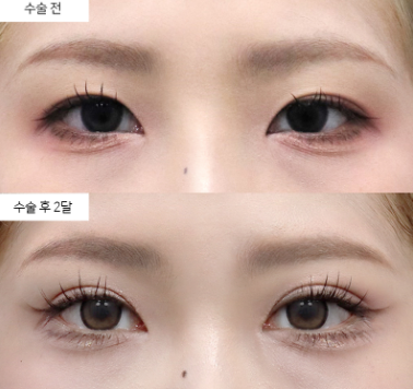 눈성형 후 붓기, 완전히 빠지는 데 얼마나 걸릴까요?