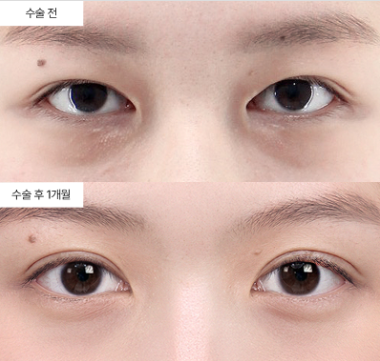 자연유착법이 일반 매몰법이랑 차이가 뭘까요?