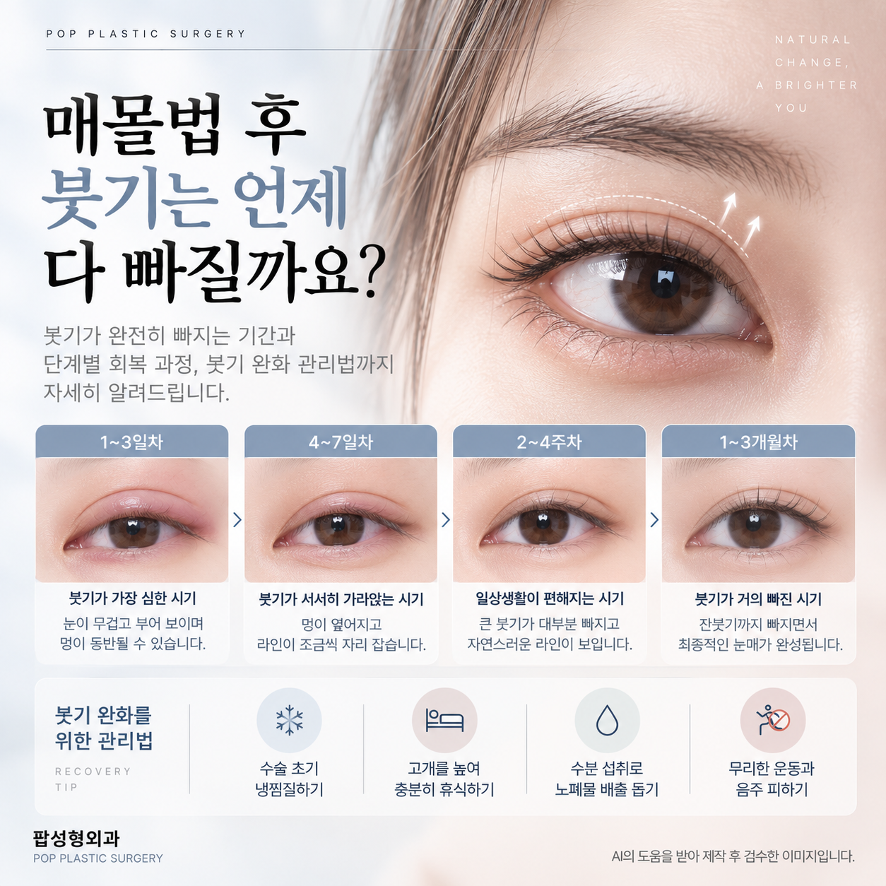 매몰법 후 붓기가 완전히 빠지는 데 얼마나 걸리나요?