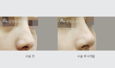 코끝성형 후 붓기, 왜 이렇게 오래 가는 건가요?