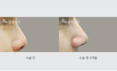 콧대성형 비용, 병원마다 왜 이렇게 다른가요?