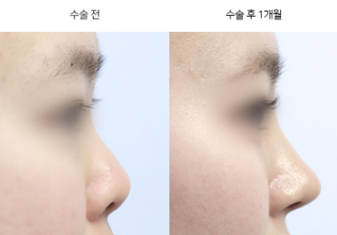들창코는 왜 생기는 건가요?