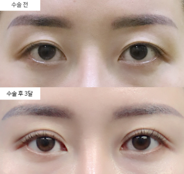 졸린눈 수술 후 눈이 더 이상해 보이는 부작용, 왜 생기는 걸까요?