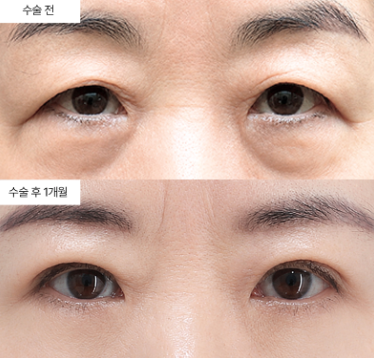 눈썹거상 비용, 어떤 요인이 가격을 결정할까요?