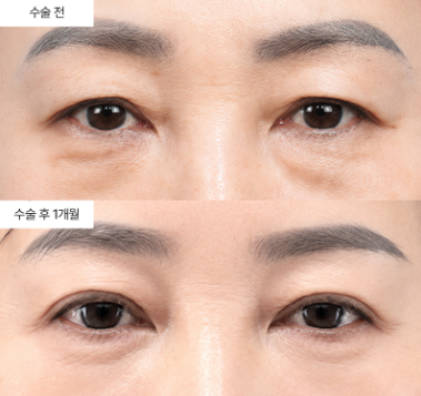 하안검 수술 후 회복, 주차별로 어떻게 달라질까요?