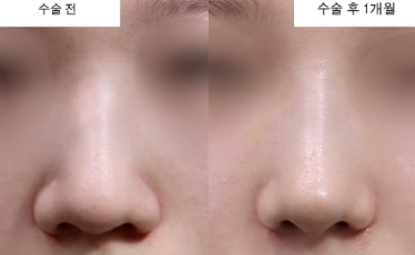 복코인 줄 알았는데 피부 탓? 뭉툭한 코끝 유형별 교정법