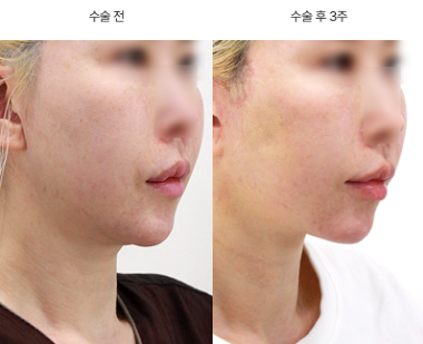 안면거상 유지기간, 10년 가는 사람과 2년 만에 처지는 사람의 차이