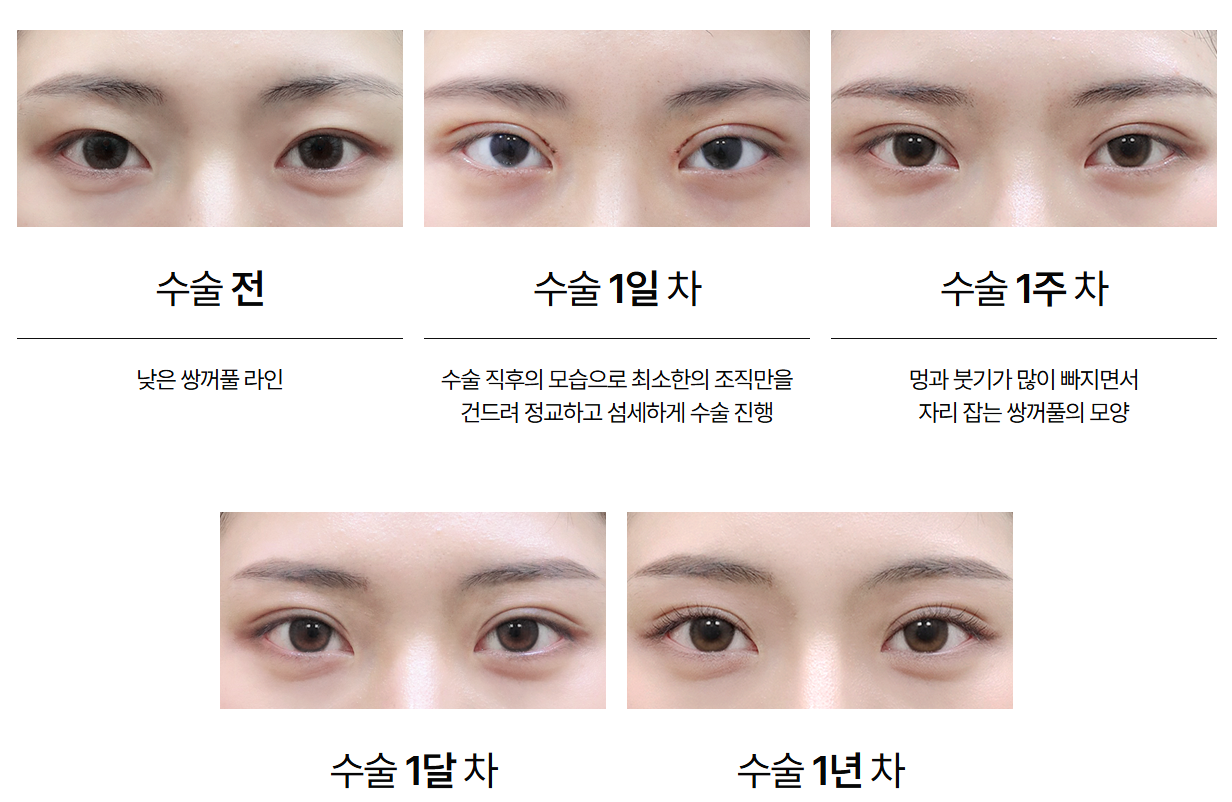 자연유착 붓기, 날짜별로 이렇게 빠져요: 수술 당일부터 한 달까지