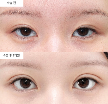 뒤밑트임, 뒤트임만 할 때와 무엇이 다를까? 눈꼬리가 내려가 보이는 원리