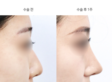 콧대 높이기, 보형물만 넣으면 끝일까? 내 얼굴에 맞는 높이 정하는 법