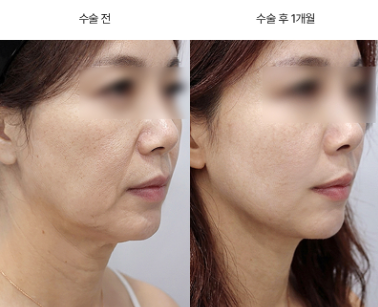안면거상 비용이 병원마다 다른 이유, 견적 비교 전 확인할 것