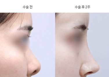 들창코 교정, 정면에서 콧구멍이 보인다면 무엇을 바꿔야 할까