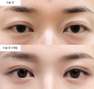 아웃라인 쌍꺼풀, 내 눈에 어울릴지 거울 앞에서 먼저 보는 법